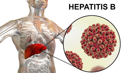 hepatitis b|Hepatitis B .